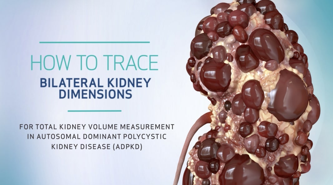 How to Trace Bilateral Kidney Dimensions, Video
