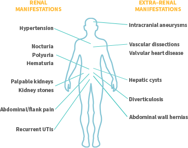 Renal and Extra-Renal Manifestations in Patients with ADPKD
