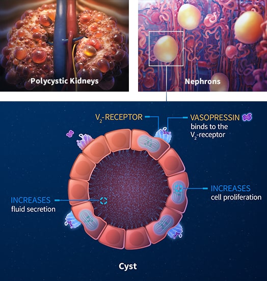 Role of Vasopressin in ADPKD Progression