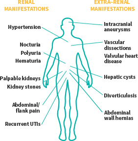 Renal and Extra-Renal Manifestations in Patients with ADPKD