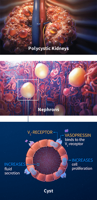 Role of Vasopressin in ADPKD Progression