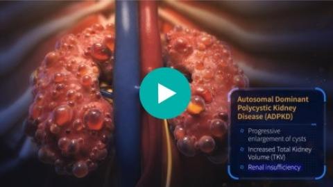ADPKD and Assessing Disease Progression, Video